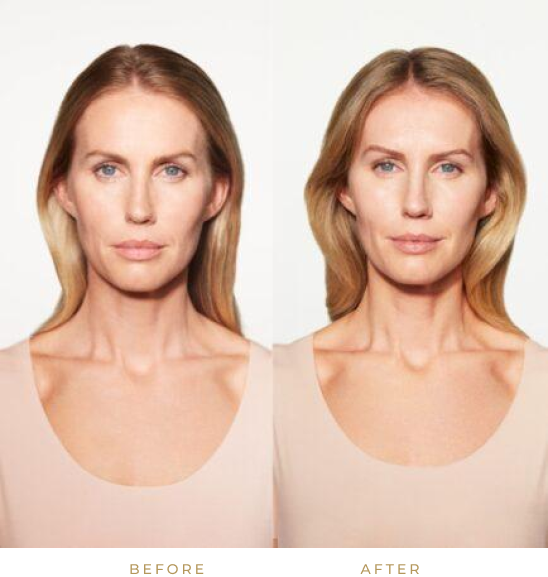 Before and after Sculptra